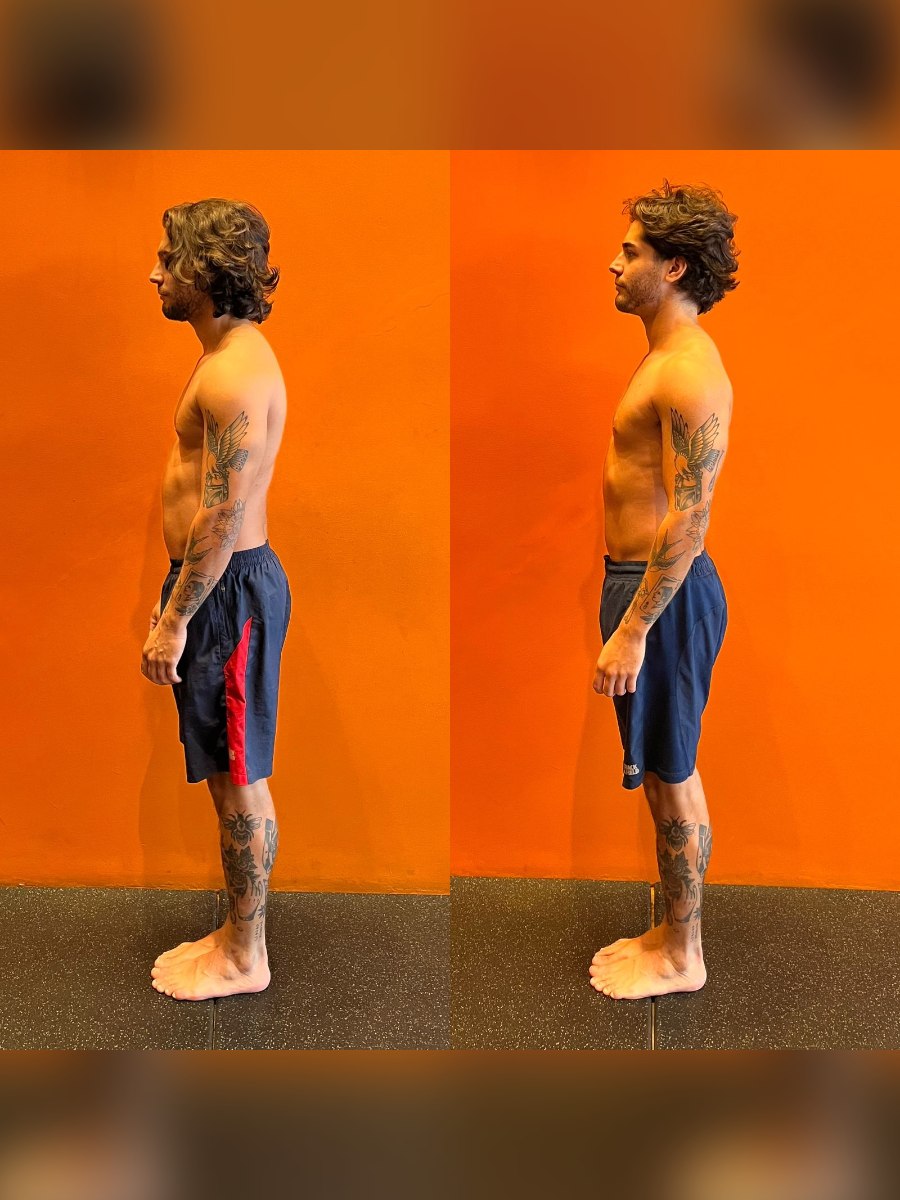 Comparação de avaliação postural de perfil, antes e depois do tratamento